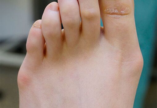 Valgus's feet