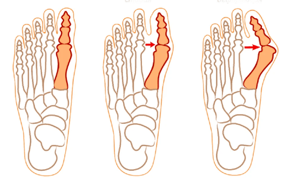 Hallux Deformy Valgus