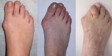 stage of hallux valgus