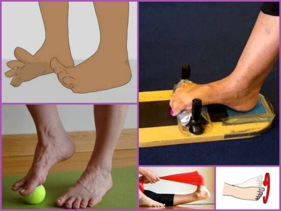 Exercise therapy for plano-valgus foot deformity