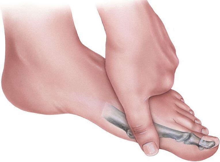 Foot pain with plano-valgus deformity