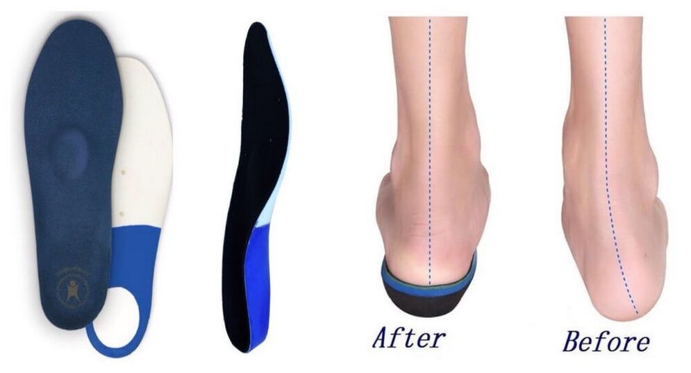 Orthopedic insoles for plano-valgus foot deformity