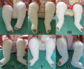 Casting procedures, each of which changes the position of the foot
