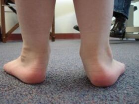 Flat valgus deformity of the foot in a child