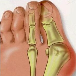 Reasons of Valgus