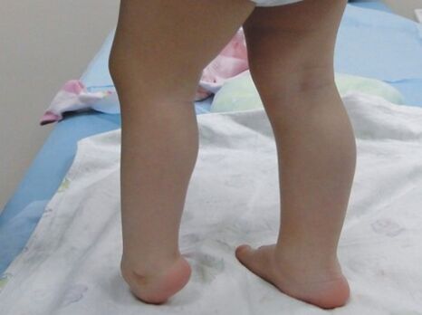 The first symptoms of the deformation of valgus feet