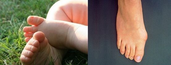 Valgus Deformation of the first finger of the foot