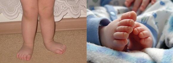 Valgus Foot deformation