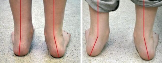 Valgus's feet