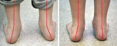 Curvature Valgus